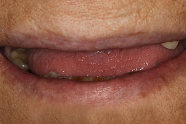 Teeth Cleaning in Florham Park