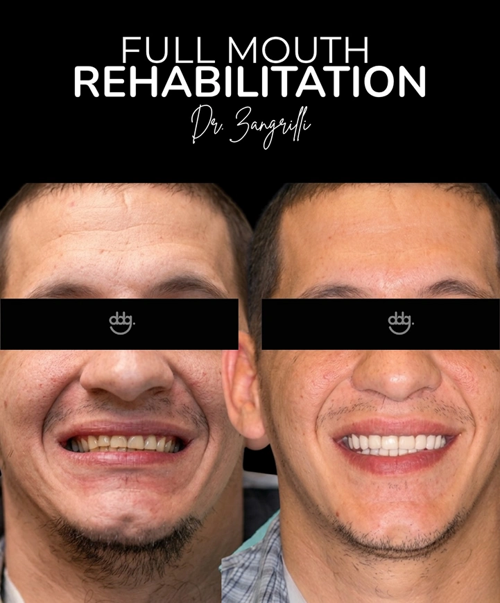 Before and after smile makeover showing improved tooth appearance and a brighter smile.
