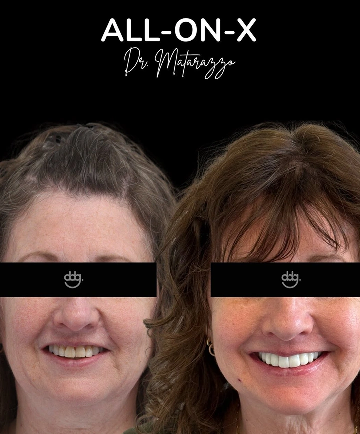 Before and after cosmetic dental treatment showing a brighter, healthier-looking smile.