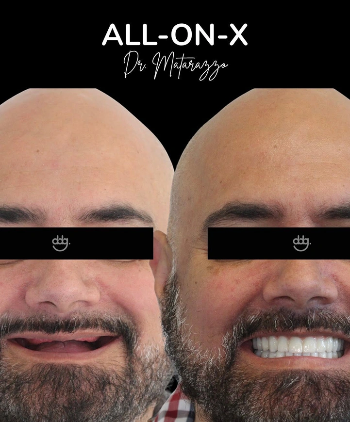 Before and after dental restoration showing enhanced smile aesthetics and improved tooth function.