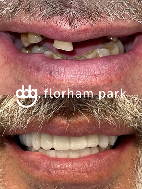 Before and after full-mouth restoration showing improved tooth function and smile appearance.