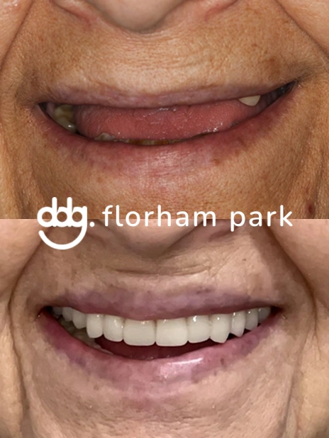 Before and after dental implant treatment showing restoration of missing teeth and a complete smile.