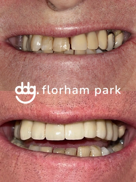 Before and after smile rehabilitation showing enhanced dental aesthetics and restored confidence.